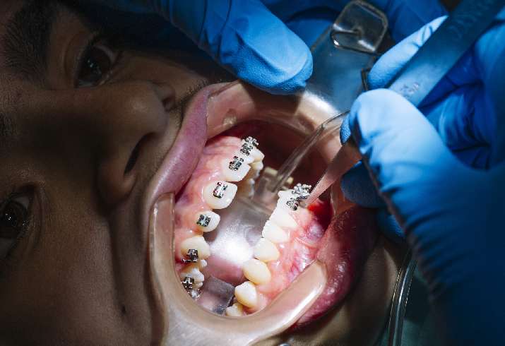 Orthodontic Treatments