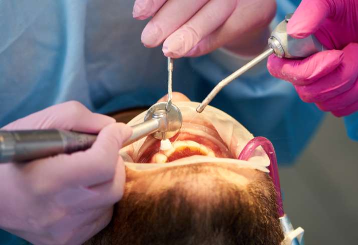 Root Canal Treatment